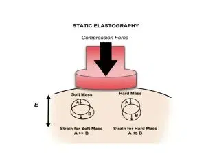 Breast Elastography