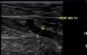 Ultrasound Assessment and Mapping of the Superficial Venous System