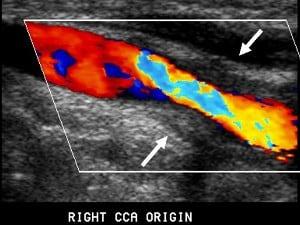 Vascular Arteritis