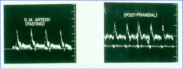 Mesenteric Ischemia