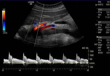 Mesenteric Duplex Examinations