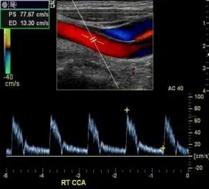 Basics of Extracranial Carotid Artery Duplex Ultrasound