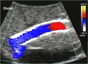 Sonography of TIPS