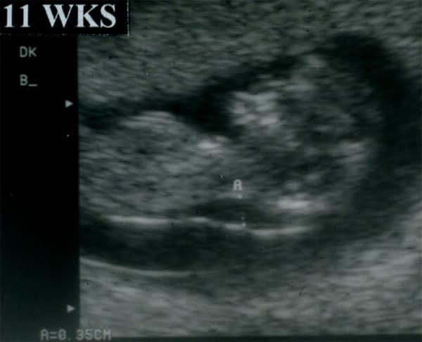 The Sonographic Detection of Trisomy 13