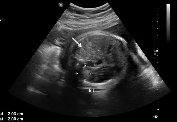 Congenital Diaphragmatic Hernia