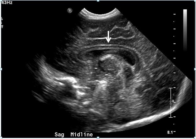 Absence of the Cavum Septum Pellucidum