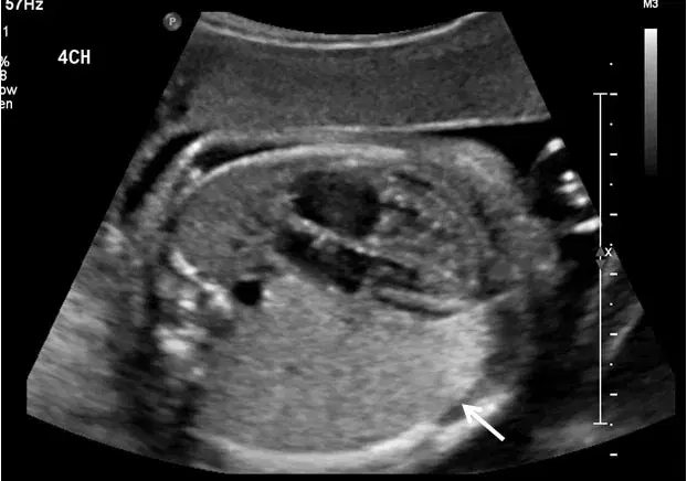 Congenital Pulmonary Airway Malformation