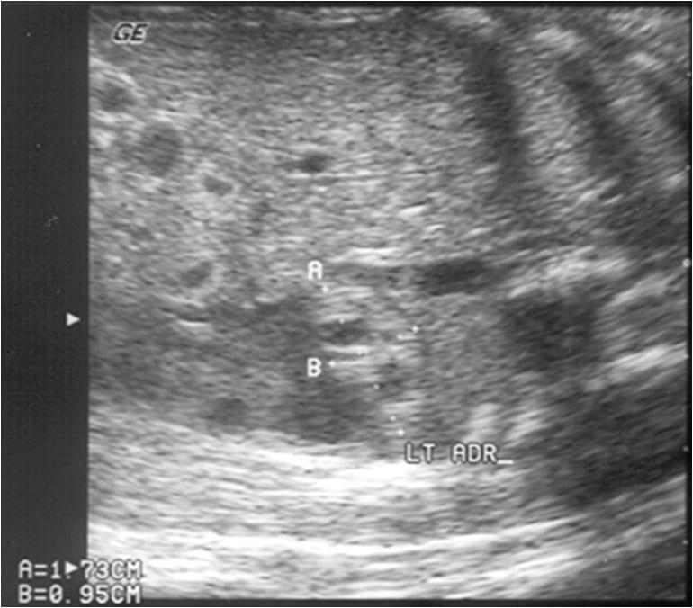 Fetal Bronchopulmonary Sequestration