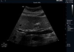 Liver Duplex Examination