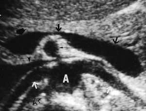 Sonographic Evaluation of the Hepatoportal System