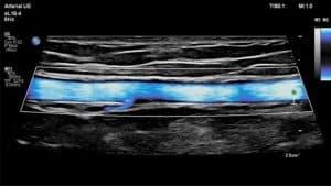 Fundamentals for Interpreting Noninvasive Vascular Testing