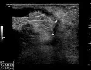 Arteriovenous Fistula, Part 2: Duplex Diagnostics and Troubleshooting