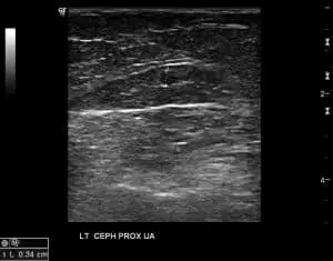 Arteriovenous Fistula, Part 1: Planning and Initial Evaluation