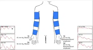 Arteriovenous Fistula, Part 3: Physiologic Testing in Ischemic Steal Syndrome