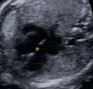 Fetal Cardiac Screening