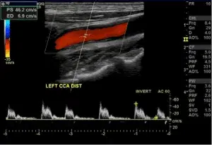 Case Studies in Cerebrovascular Duplex Imaging - Series 1