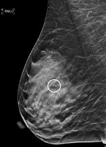 Stereotactic Breast Biopsy: Accreditation Process and Case Review