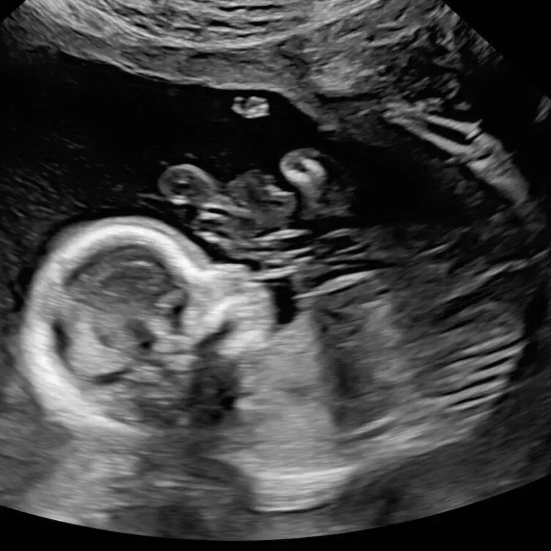 Anatomy Scan - OBGYN Ultrasound CME Course Content