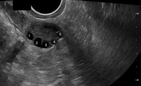 Ovarian Antral Follicle Evaluation Course Banner Image