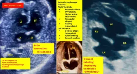 Part II: Identifying Congenital Heart Defects Using the 4-Chamber View