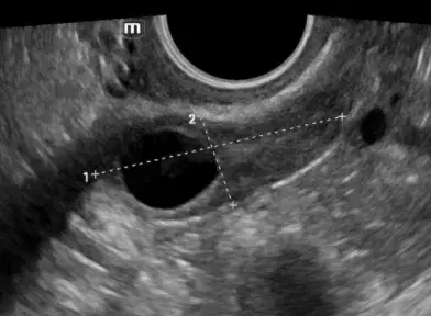 Simple Ovarian Cysts Course Banner Image