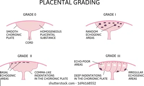 Placental Grading Across Gestation: Normal Maturation vs Pathology