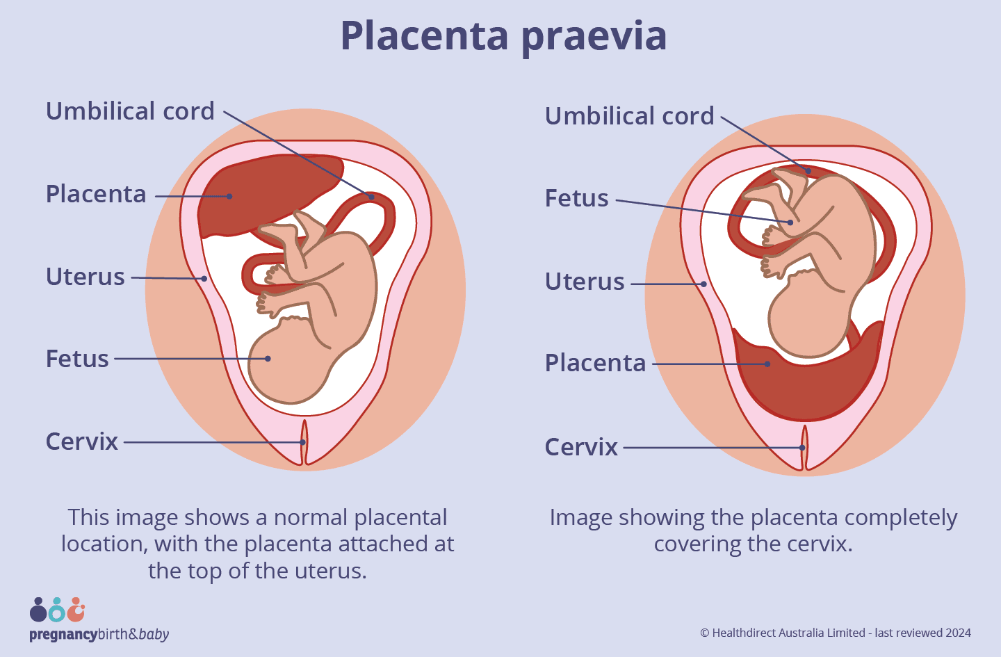 Placenta Previa & Low-Lying Placenta: Measurement, Terminology, and Follow-Up