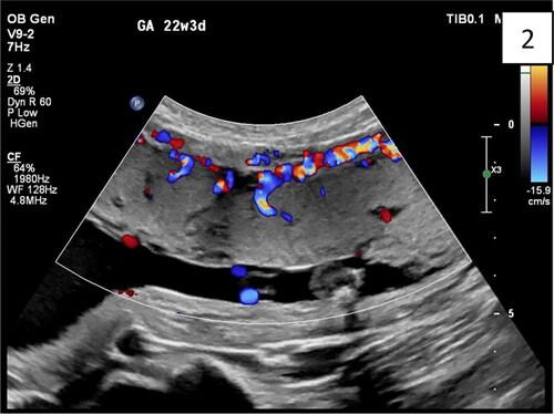 Placenta Accreta Spectrum: Accreta, Increta, Percreta-Ultrasound Detection Essentials