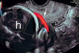 Vasa Previa Screening: Mapping Fetal Vessels Near the Cervix with Doppler