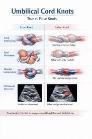 Umbilical Cord Variations: Vessel Number, Coiling Patterns, Knots, and Cysts