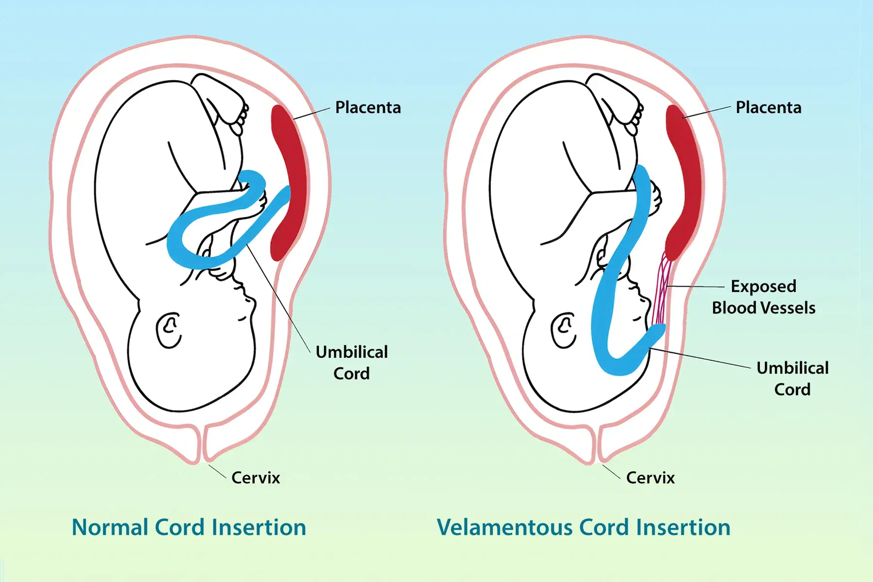 Cord Insertion Abnormalities: Central vs Marginal vs Velamentous—How to Diagnose