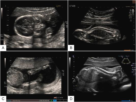 Level I Obstetric Ultrasound: Required Components, Standard Planes, and Reporting