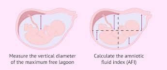 Amniotic Fluid Assessment: MVP vs AFI, Borderline Findings, and Pitfalls