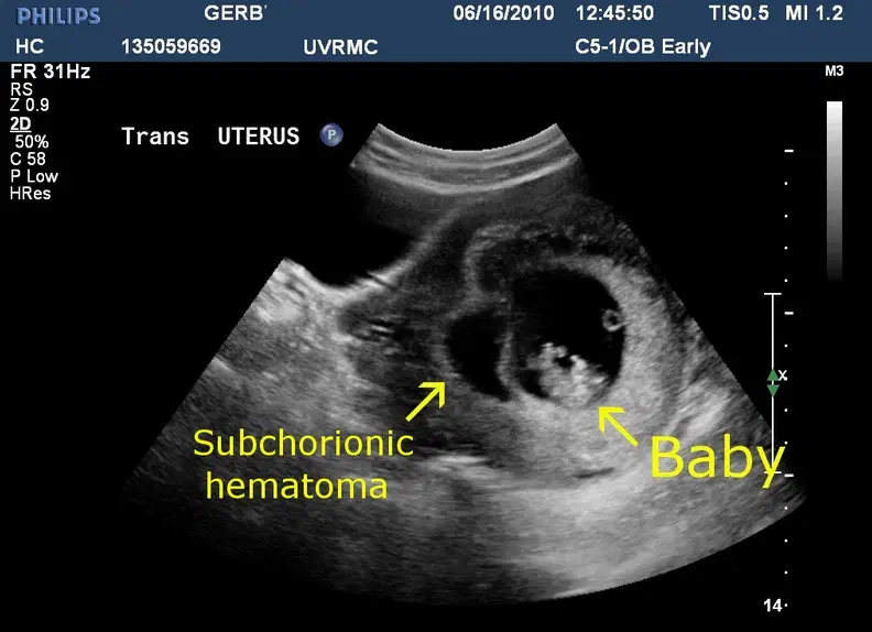 Subchorionic Hemorrhage: Accurate Identification and Documentation