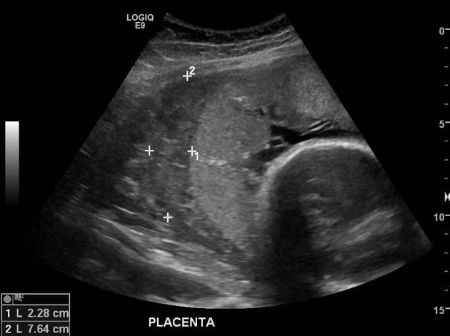 Placental Abruption: Sonographic Patterns, Limitations, and Escalation Triggers