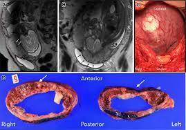 Placenta Localization for Delivery Planning: Prior Cesarean, LUS Assessment, and PAS Risk