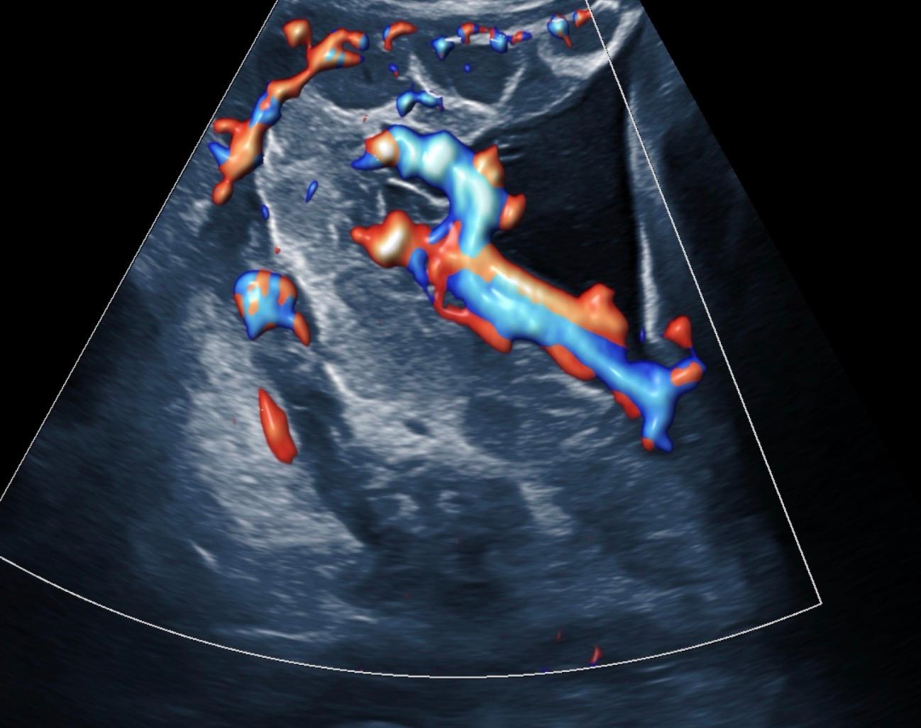Placental Grading Across Pregnancy: Normal Maturation vs Pathologic Change