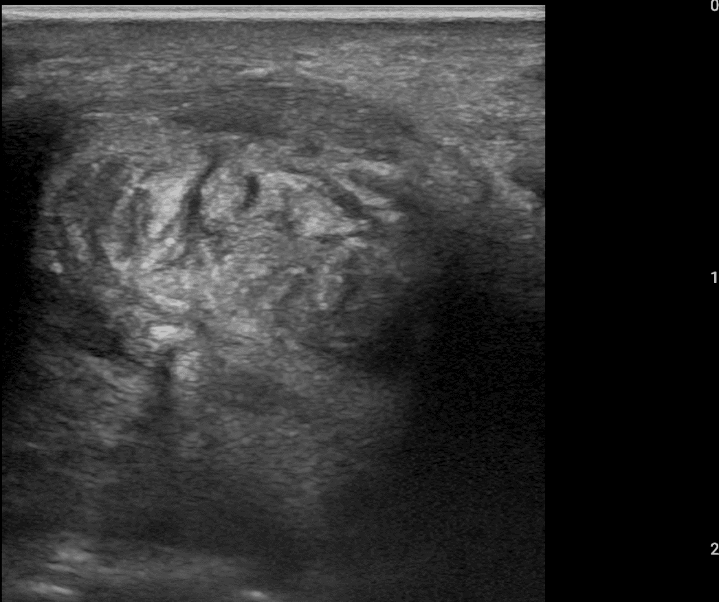 Introduction to Tendons on Ultrasound: A Common Sense Approach