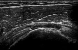 Ultrasound of the Shoulder Case Series: What is the Diagnosis?