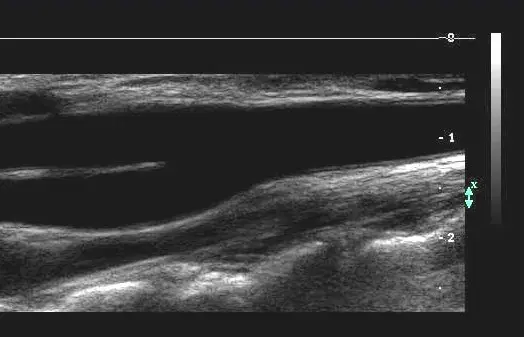 Carotid Ultrasound Case Series: What's the Diagnosis? Banner Image