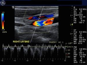 Understanding and Interpreting Spectral Waveforms in the Upper and Lower Extremities, Part 2