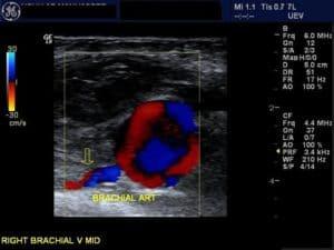 Understanding and Interpreting Spectral Waveforms in the Upper and Lower Extremities, Part 1