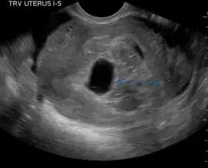 Case Studies: Threatened Abortion