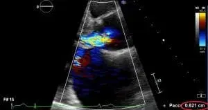Case Studies: Aortic Regurgitation (AV Disease)
