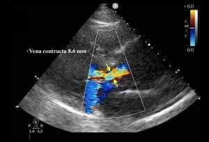 Case Studies: Aortic Regurgitation (Aortic Disease)