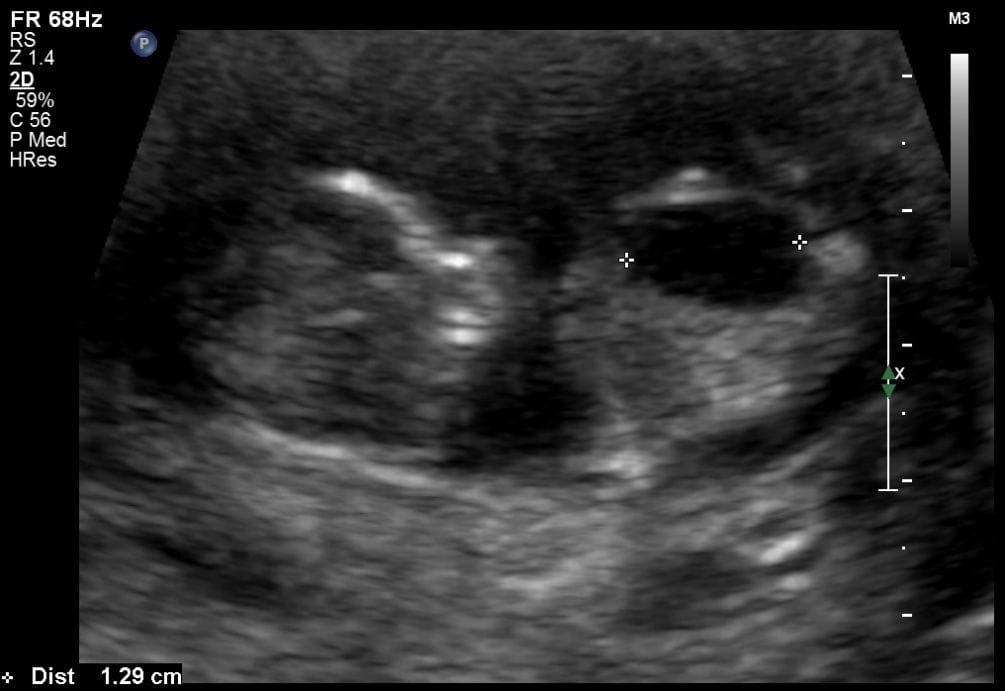 Sonographic Diagnosis of Fetal Uropathy