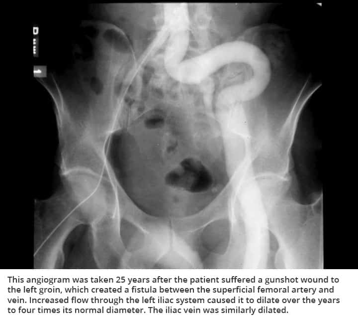 Aneurysms and Aortic Dissection