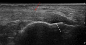 Introduction to Tendons on Ultrasound