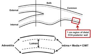 Carotid Intima-Media Thickness: CIMT Imaging