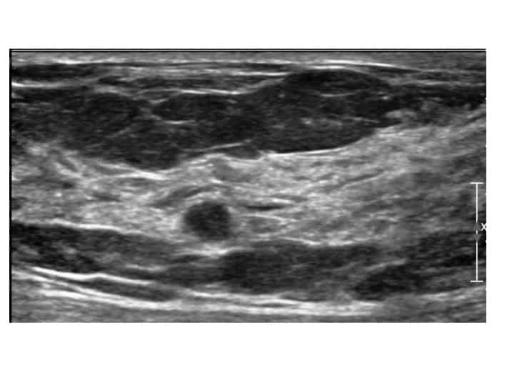 Detecting Ovarian Cysts: How Ultrasound Helps Differentiate Between Benign and Malignant